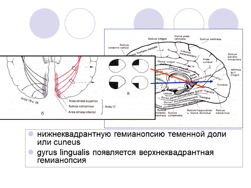 нижнеквадрантную гемианопсию теменной доли или cuneus  gyrus lingualis появляется верхнеквадрантная гемианопсия
